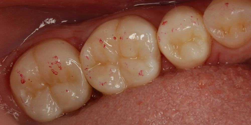 Фото после лечения. Лечение кариеса и реставрация жевательных зубов