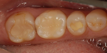 Лечение кариеса и реставрация жевательных зубов фото до лечения